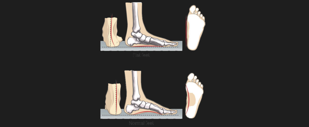 Flat Feet Old Motus Physical Therapy