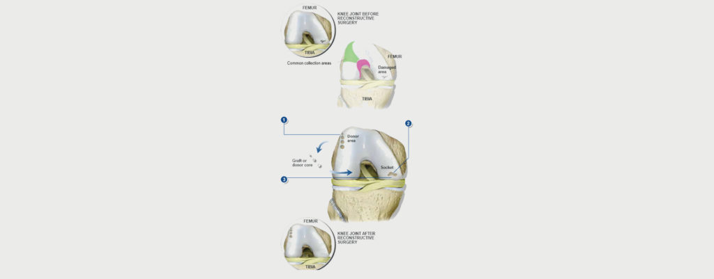 OSTEOCHONDRAL AUTOGRAFT TRANSFER SYSTEM OATS MOTUS Physical Therapy