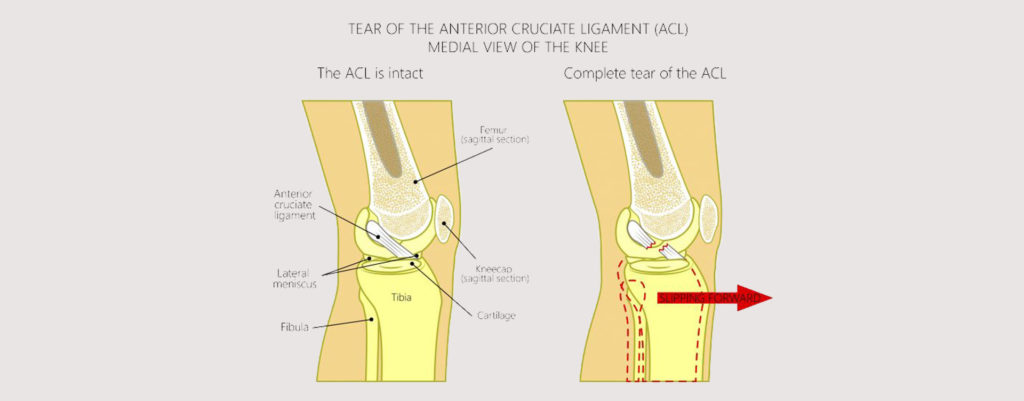 ANTERIOR CRUCIATE LIGAMENT INJURY MOTUS Physical Therapy