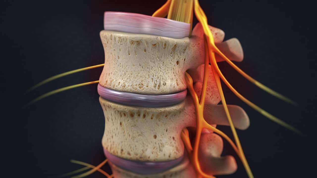 Lumbar Radiculopathy Motus Physical Therapy