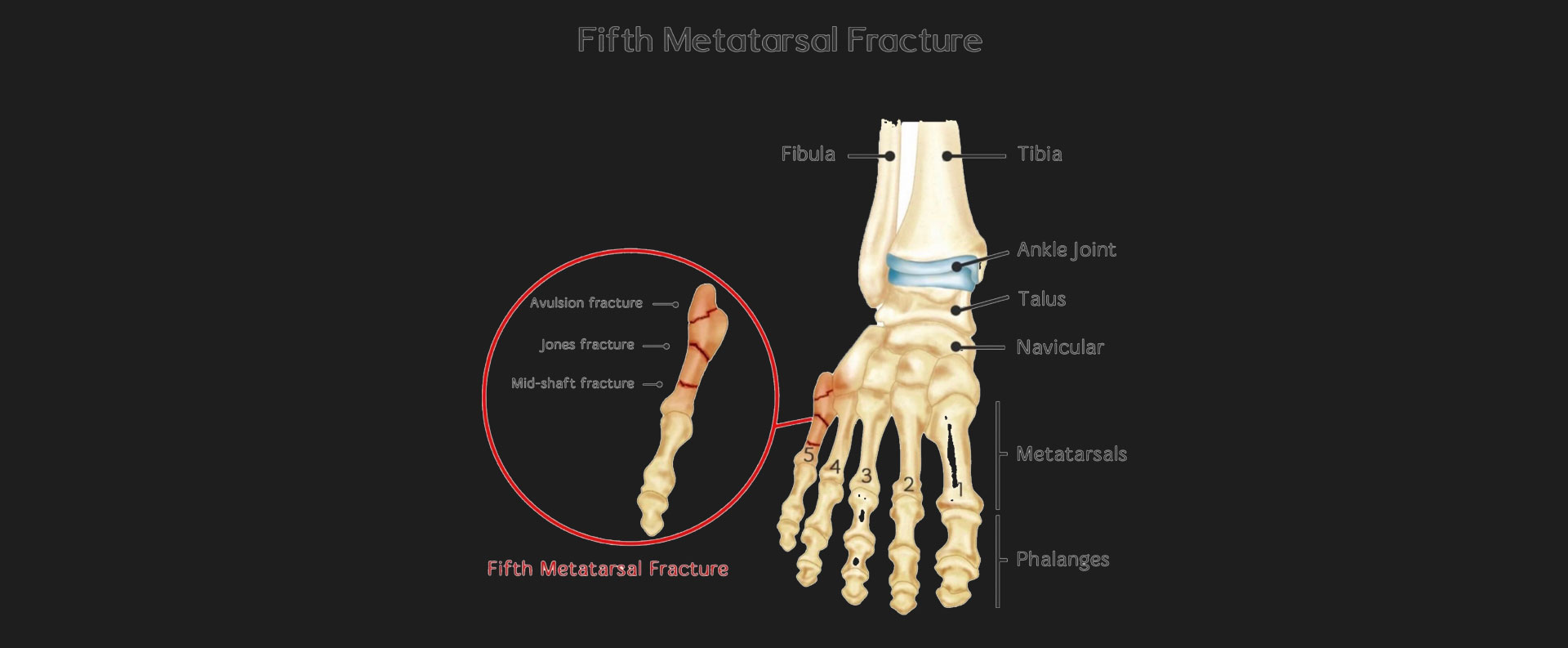 5th-Metatarsal-Fracture