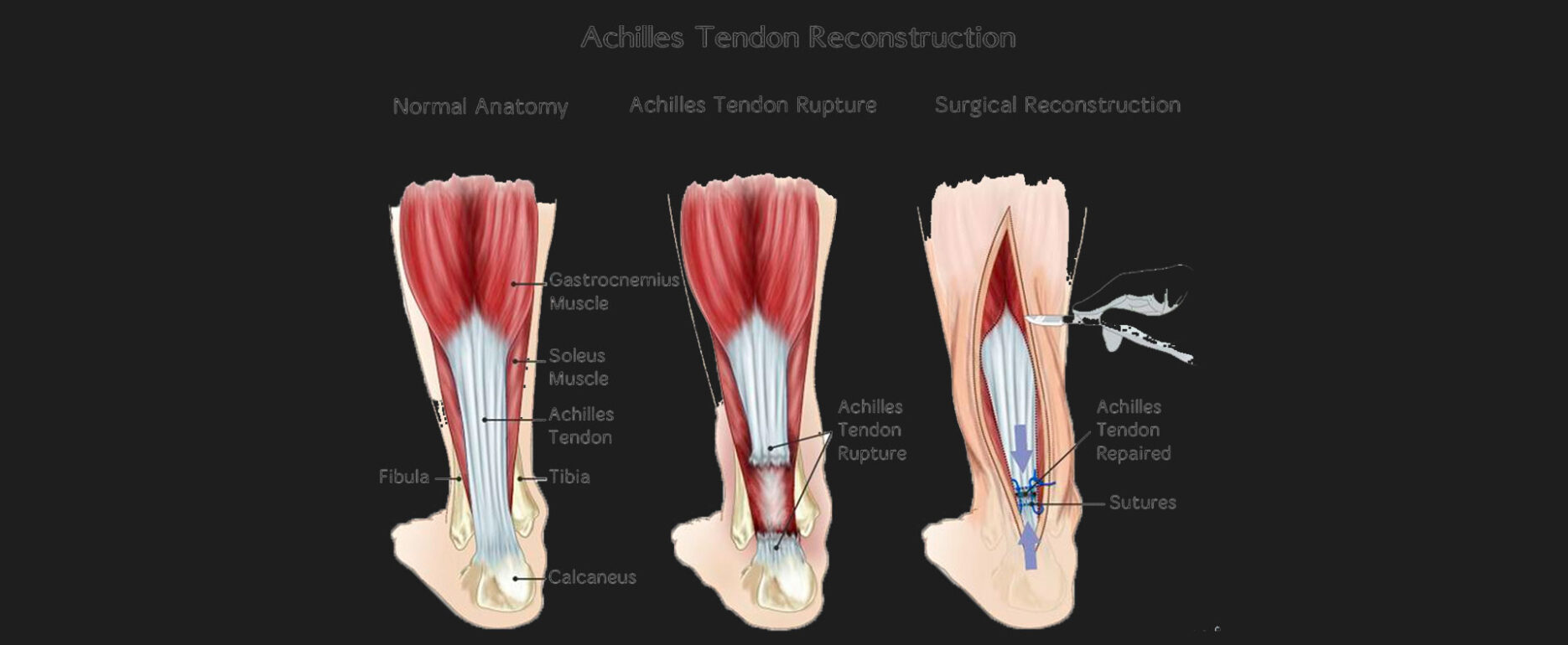 Achilles-Tendon-Repair