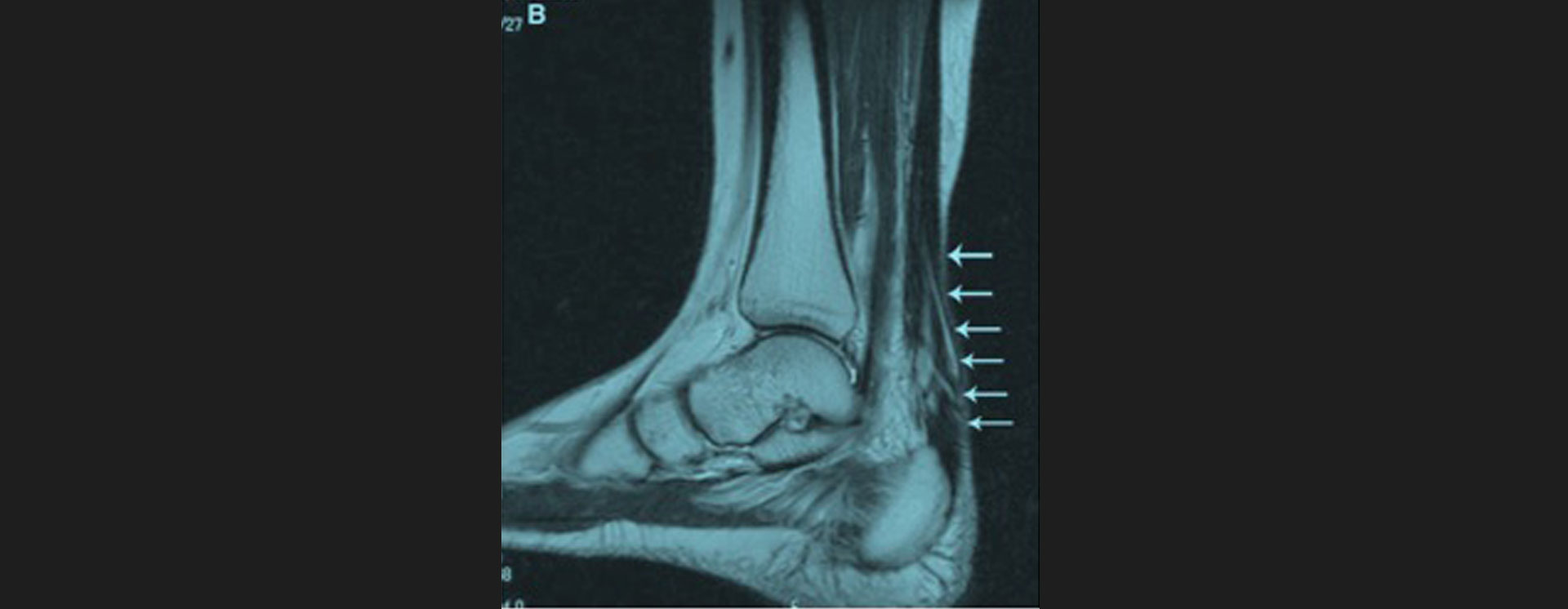 Achilles-Tendon-Repair