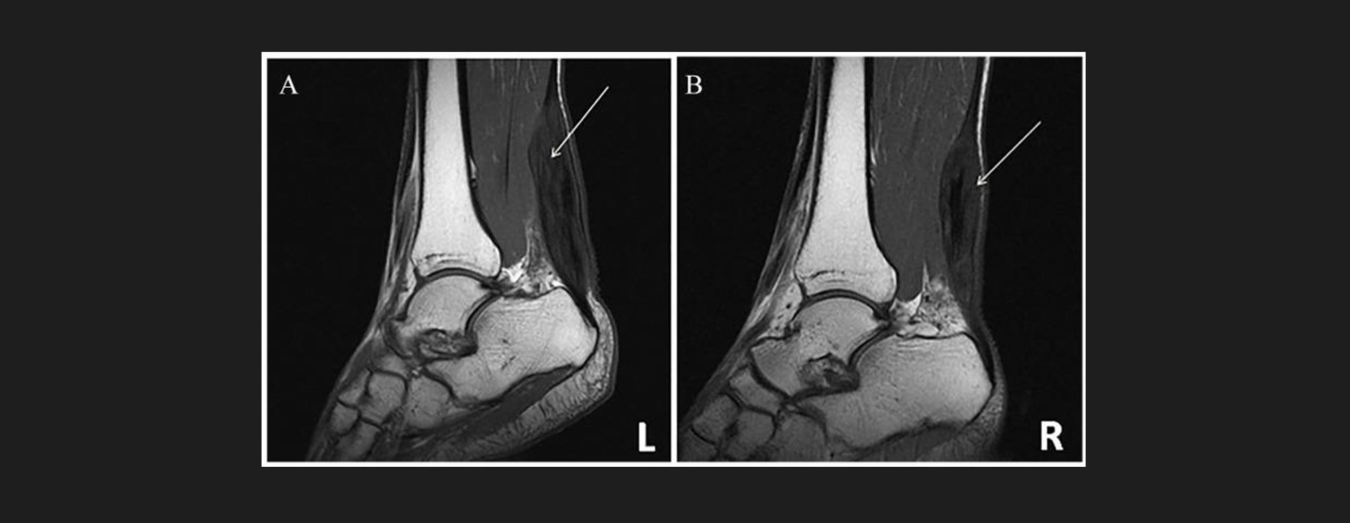 Achilles-Tendonitis