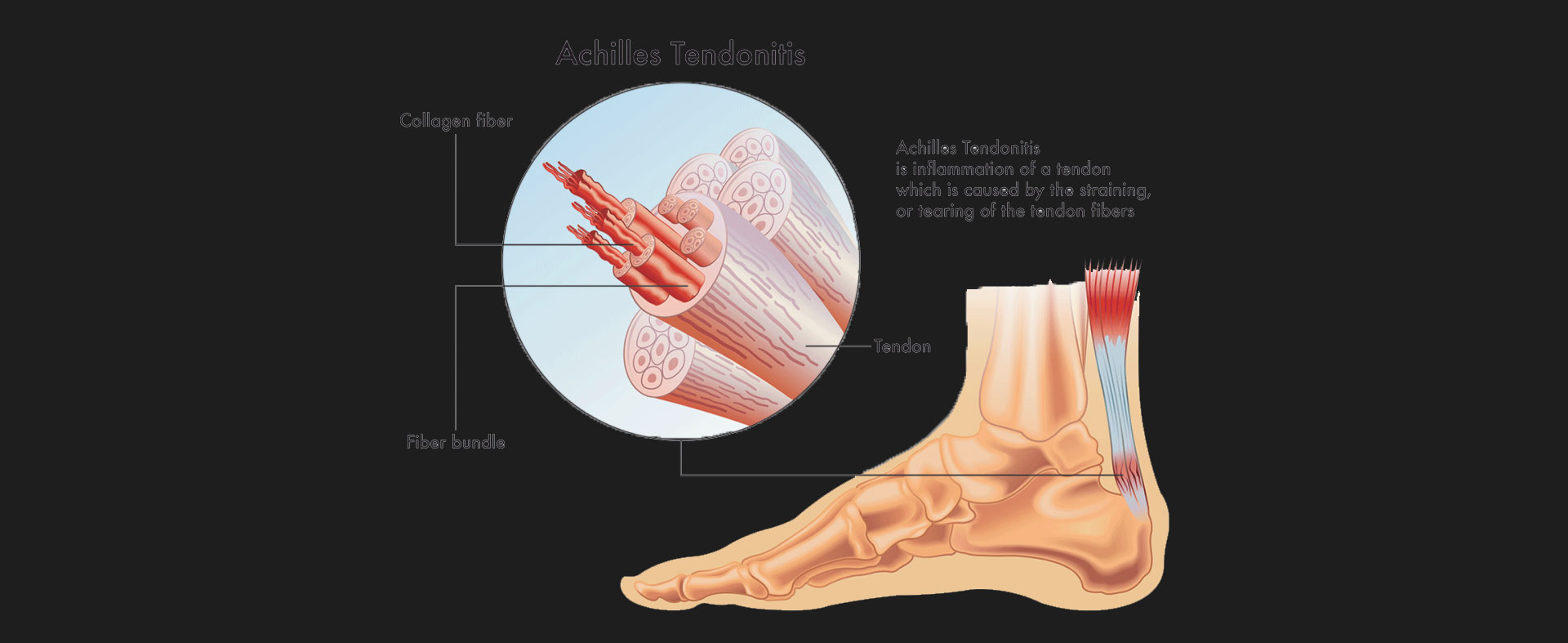 Achilles-Tendonitis