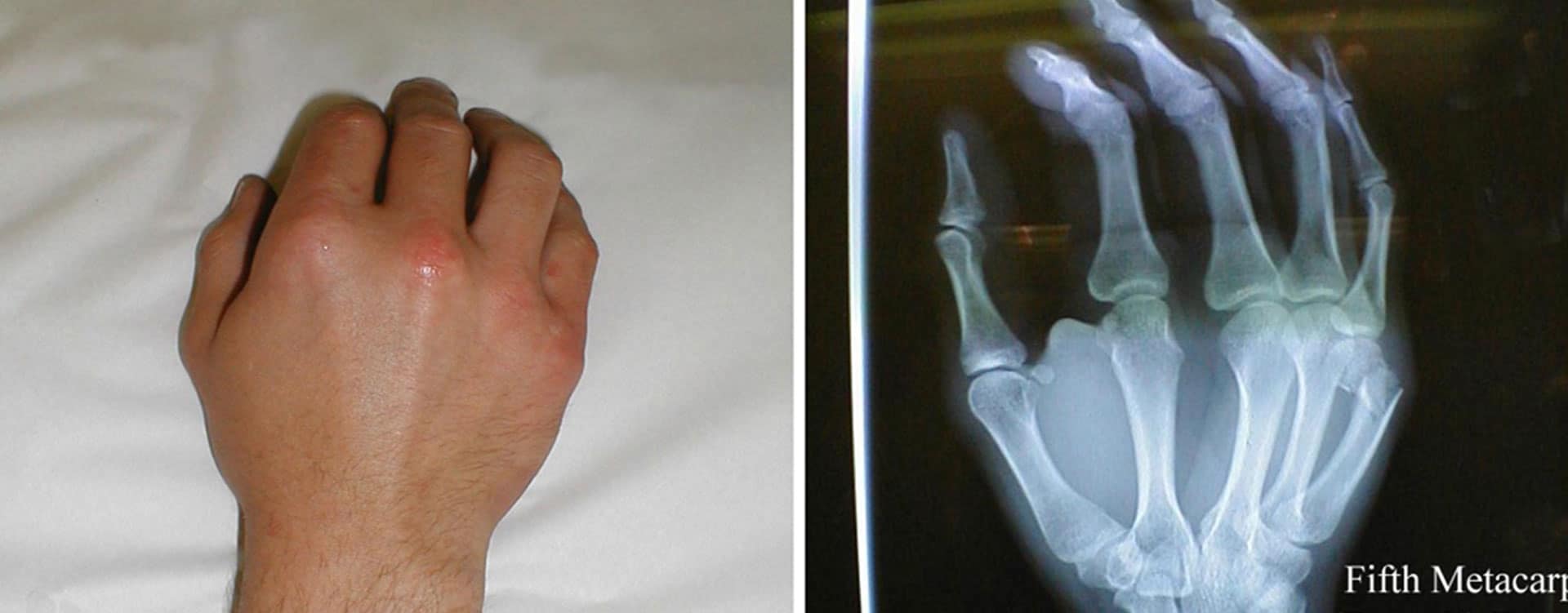 Boxers-Fracture