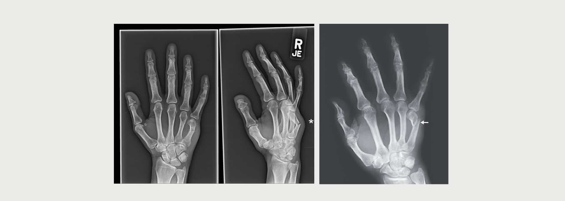 Boxers-Fracture