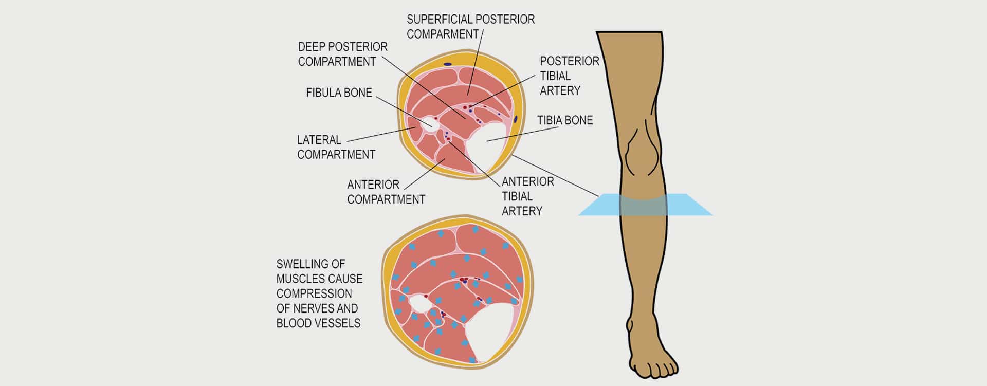 COMPARTMENT SYNDROME MOTUS Physical Therapy