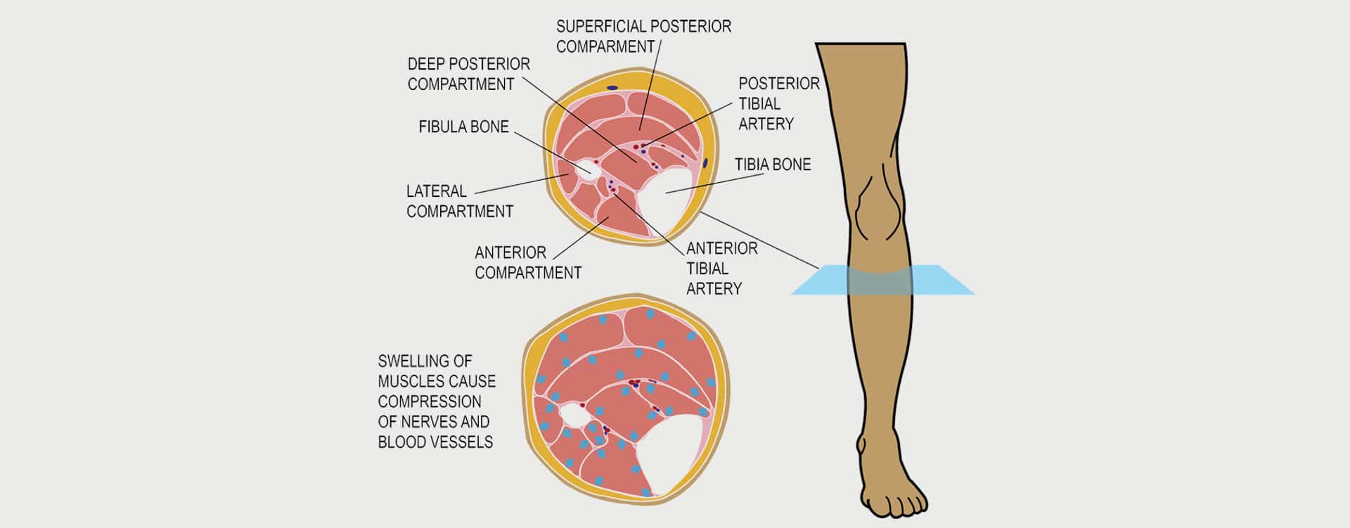 Compartment Syndrome: What is Compartment Syndrome, its Causes?