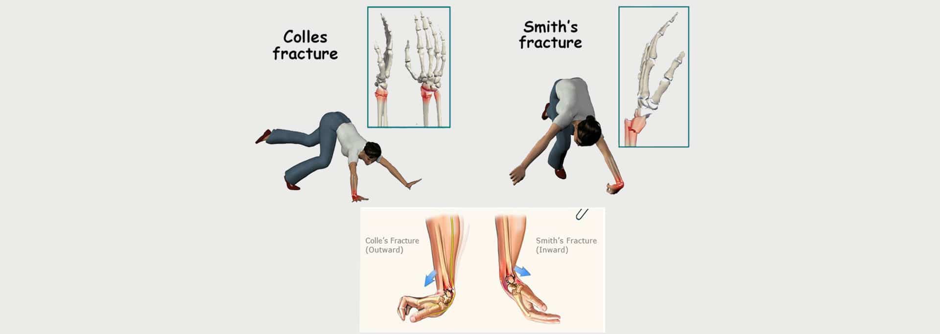 foosh-fallen-onto-an-outstretched-hand-motus-physical-therapy