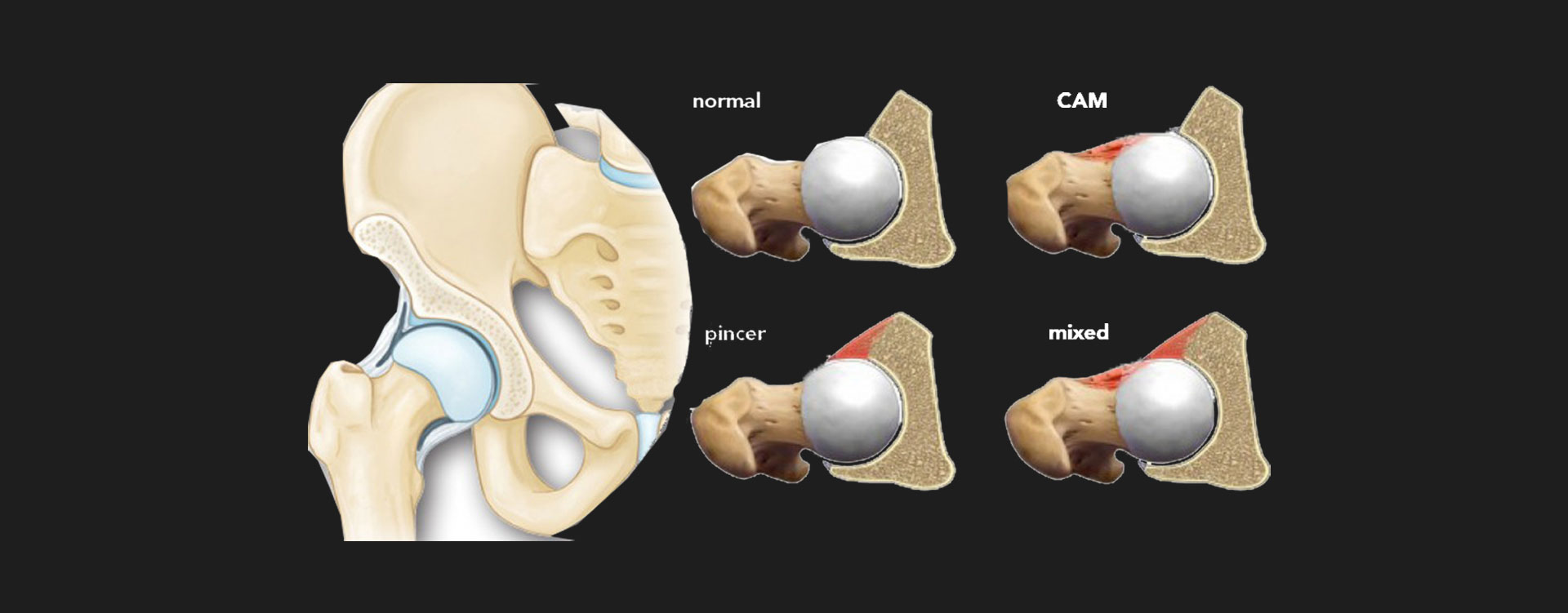 udlejeren Optø, optø, frost tø fedme FEMORAL ACETABULAR IMPINGEMENT - Motus Specialists