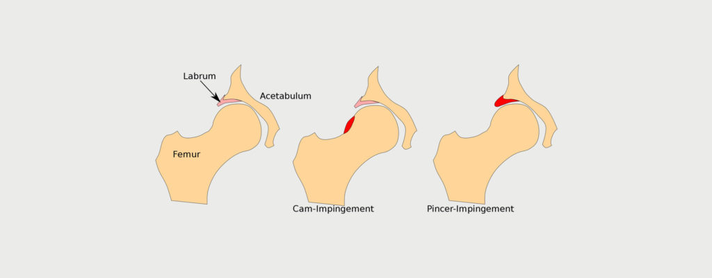 Femoral Acetabular Impingement Motus Physical Therapy