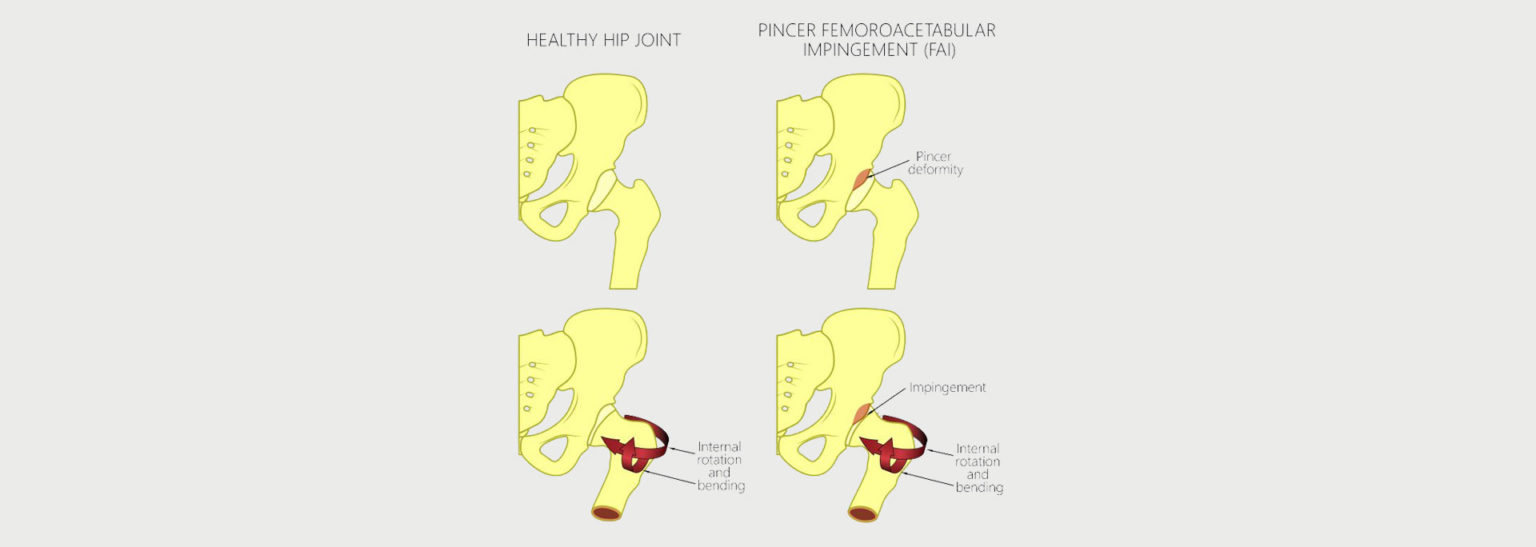 Femoral Acetabular Impingement Motus Physical Therapy