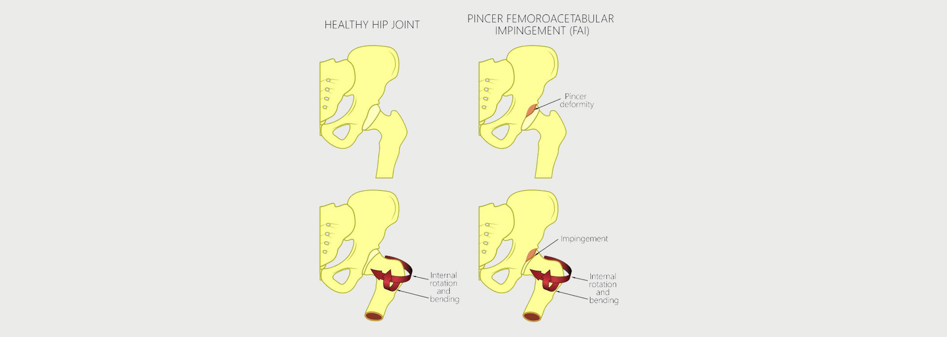 Femoral-Acetabular