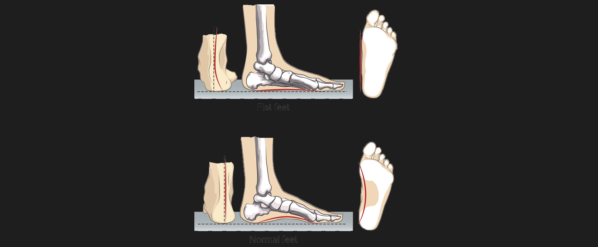 Flat-Feet
