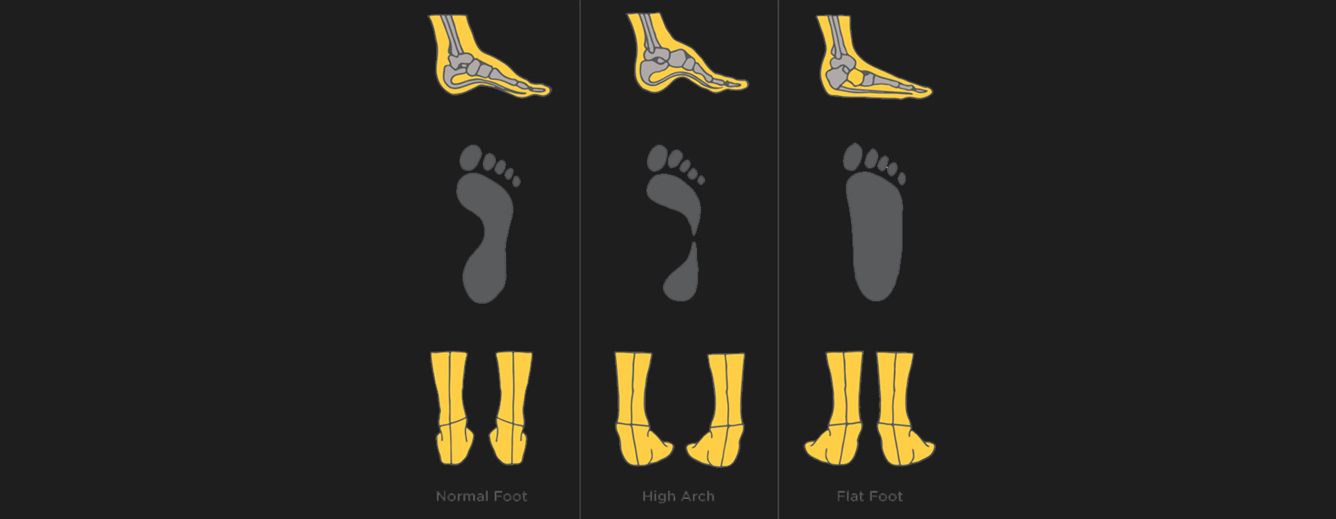 Flat-Feet