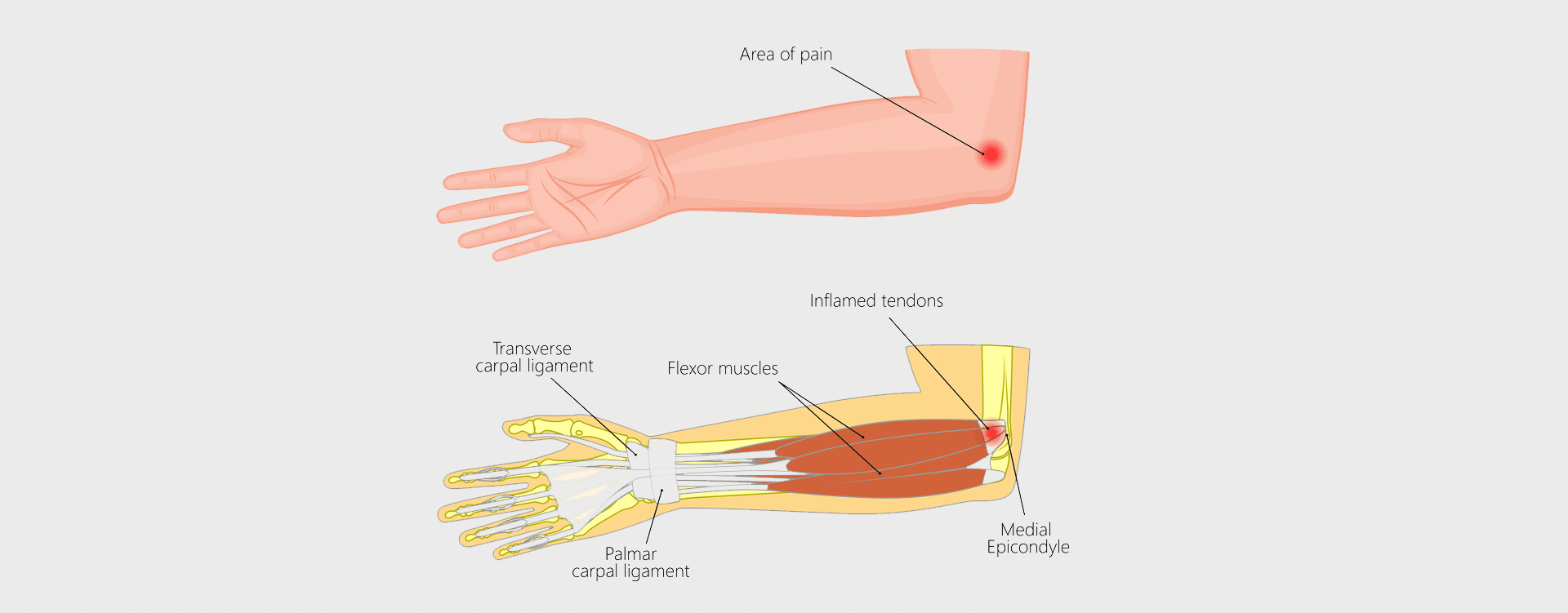 Golfers-Elbow