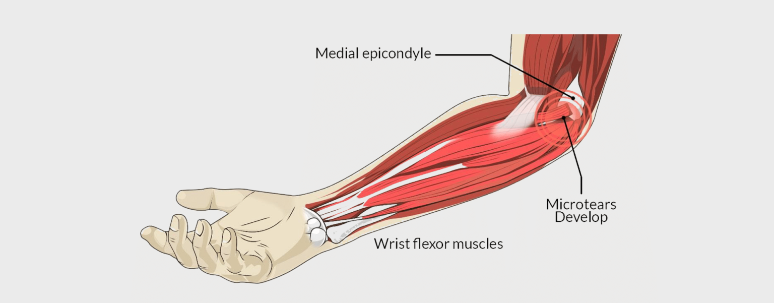 GOLFER’S ELBOW (MEDIAL EPICONDYLITIS) - MOTUS Physical Therapy