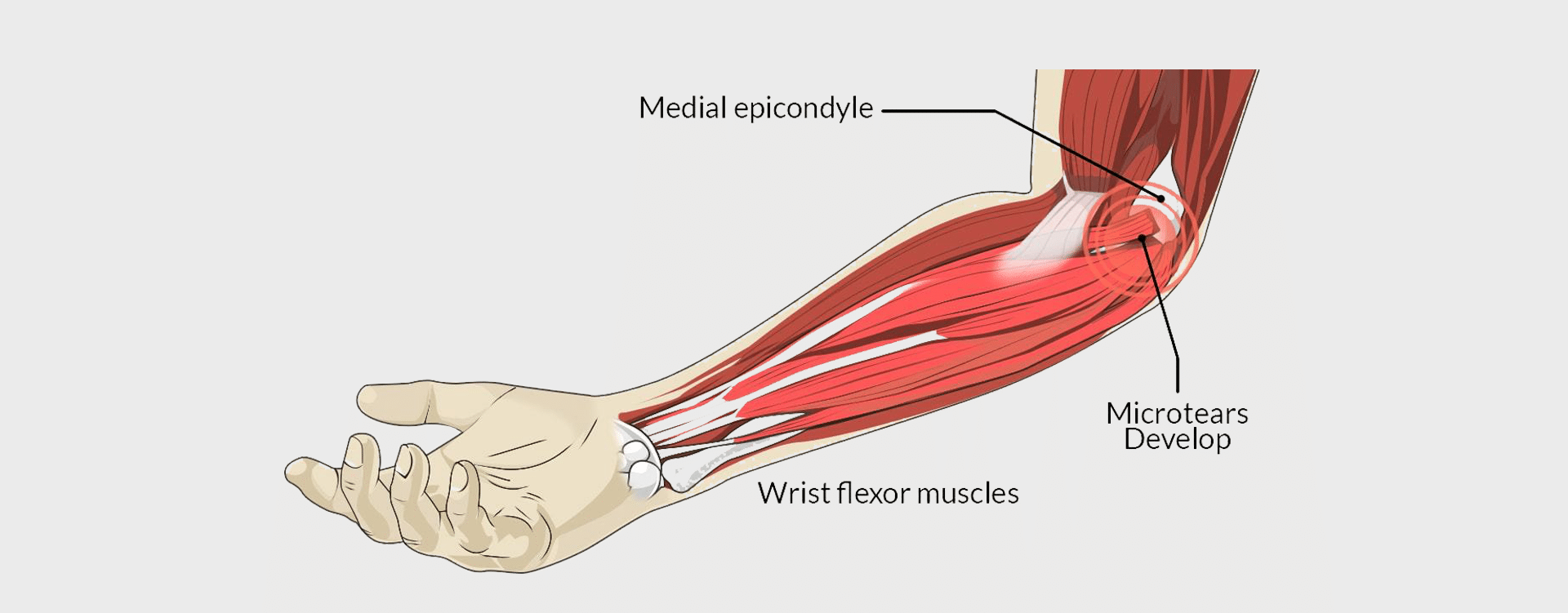 Golfers-Elbow