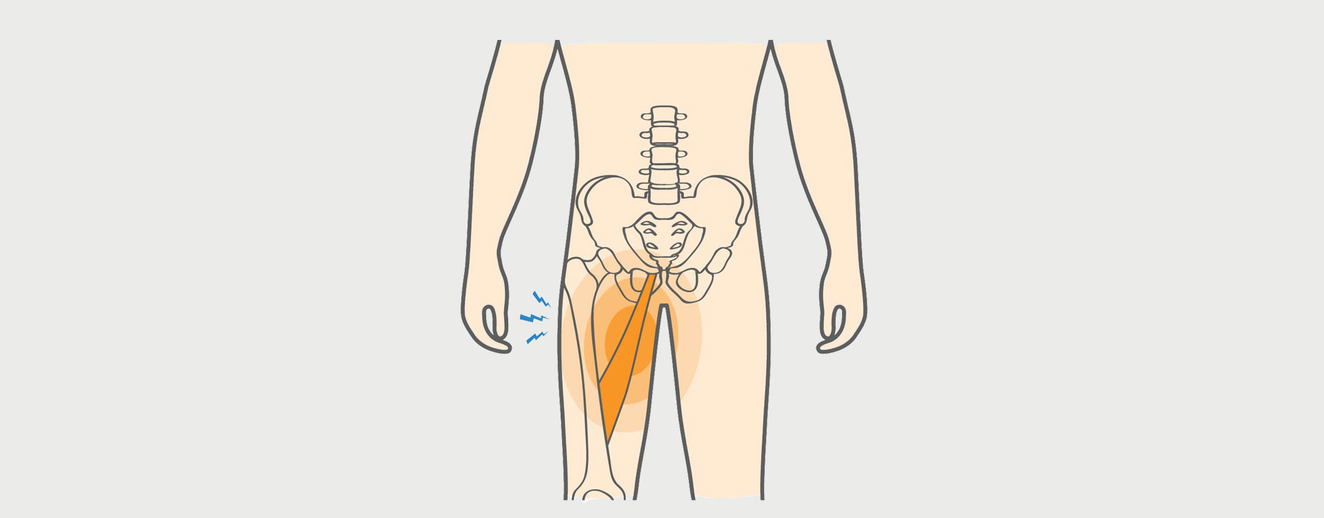 Severe Groin Tear 8034