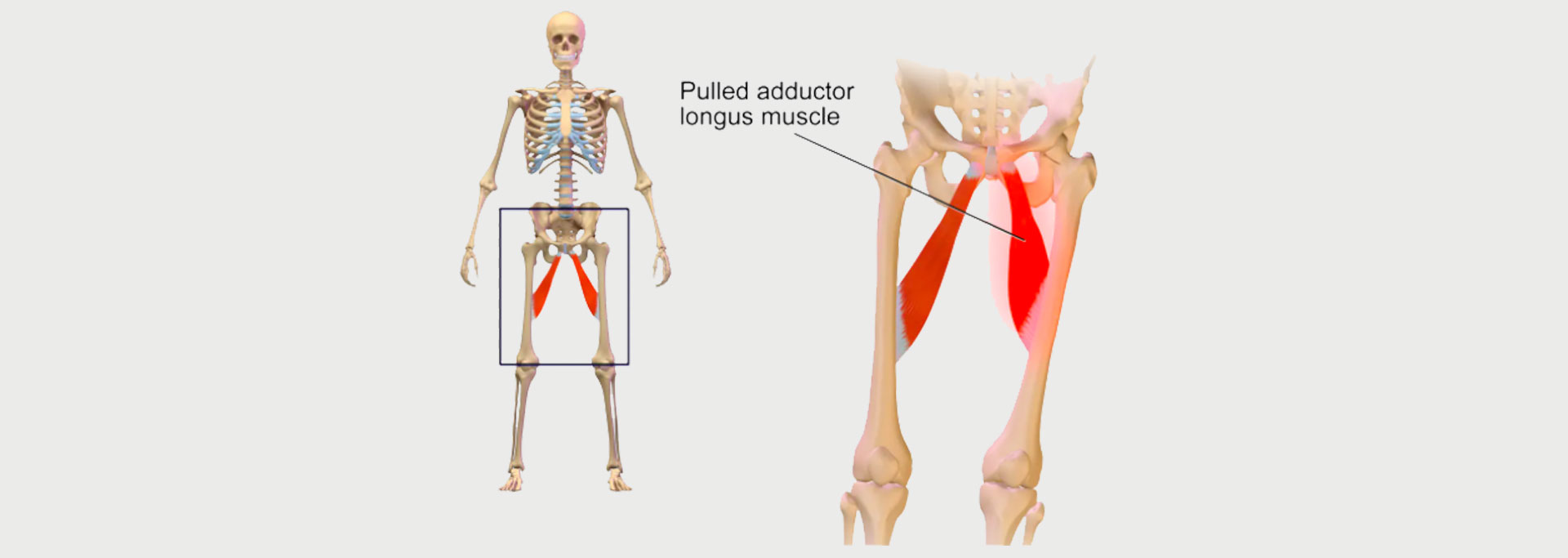 GROIN STRAIN - MOTUS Physical Therapy