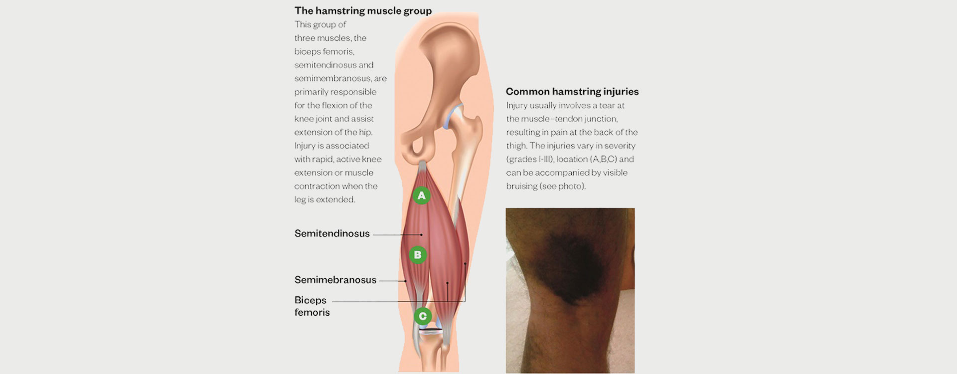 Hamstring Injury - Motus Physical Therapy