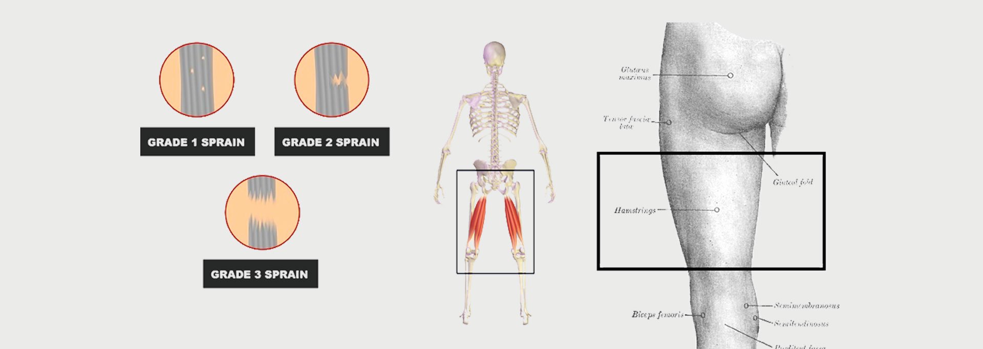 Hamstring Injury - Motus Physical Therapy