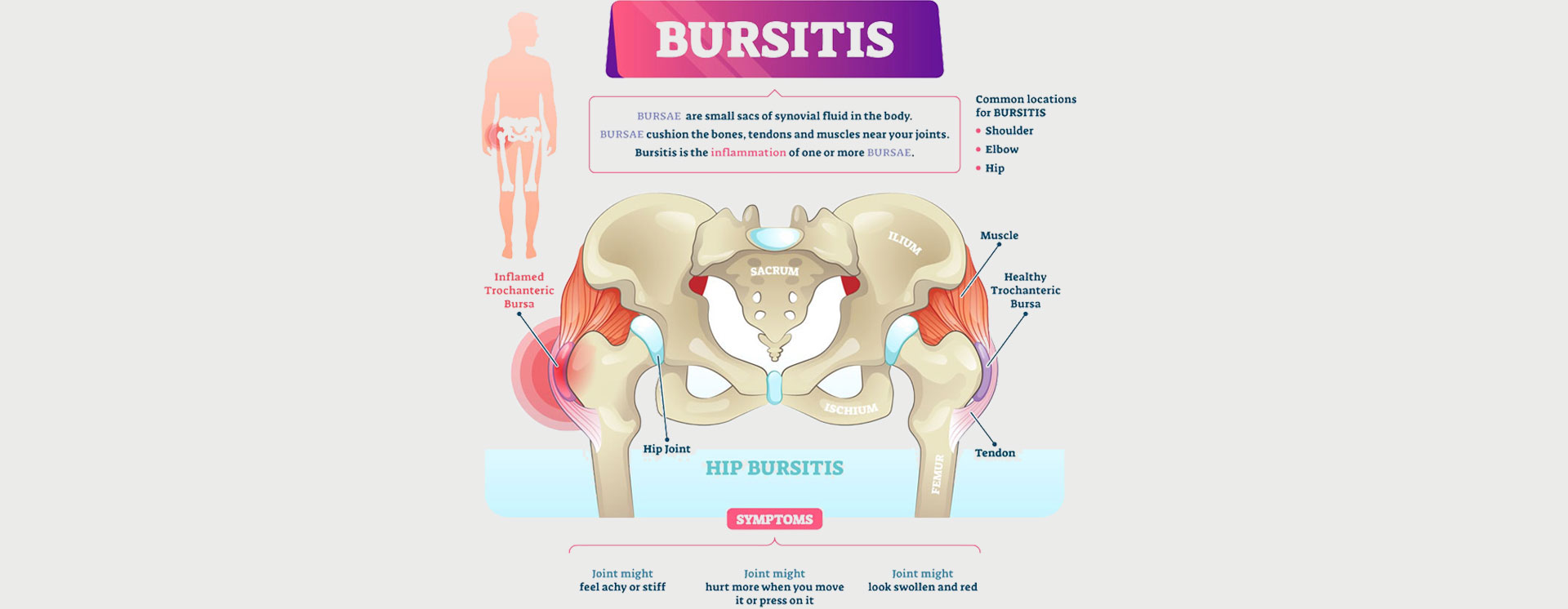 Hip-Bursitis