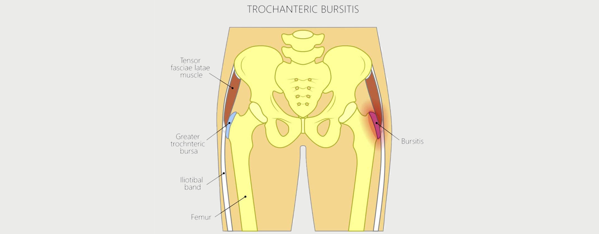 Hip-Bursitis