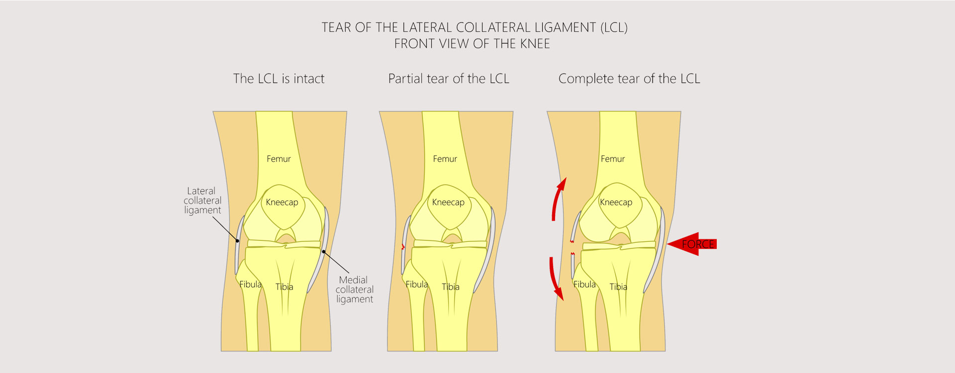 LCL-Injury