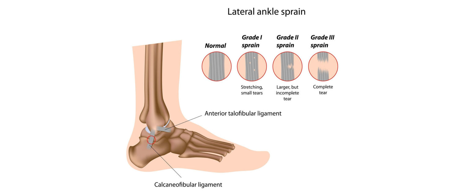 LATERAL ANKLE SPRAIN - old - MOTUS Physical Therapy