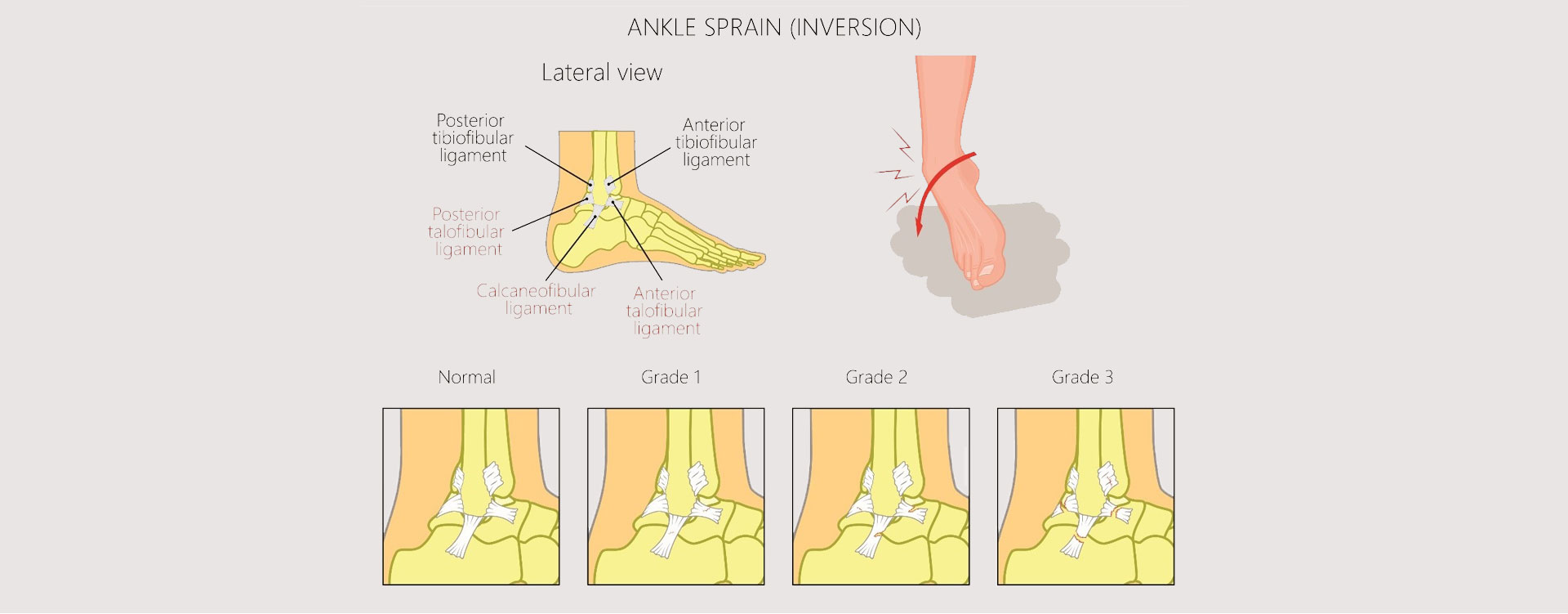 Lateral-Ankle-Sprain