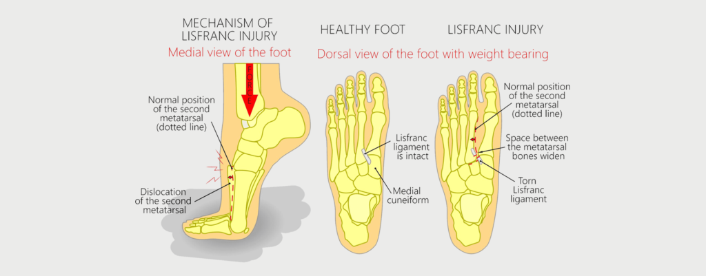 Lisfranc Fracture Motus Physical Therapy