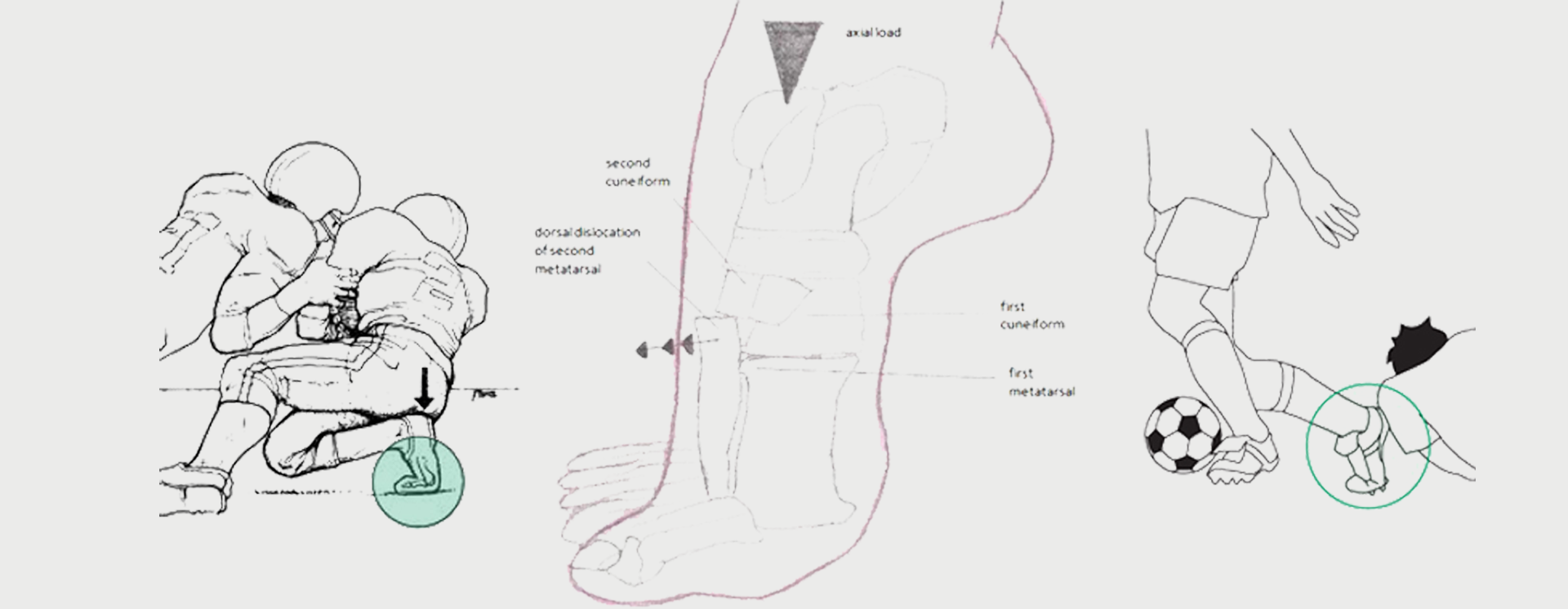 Lisfranc-Fracture