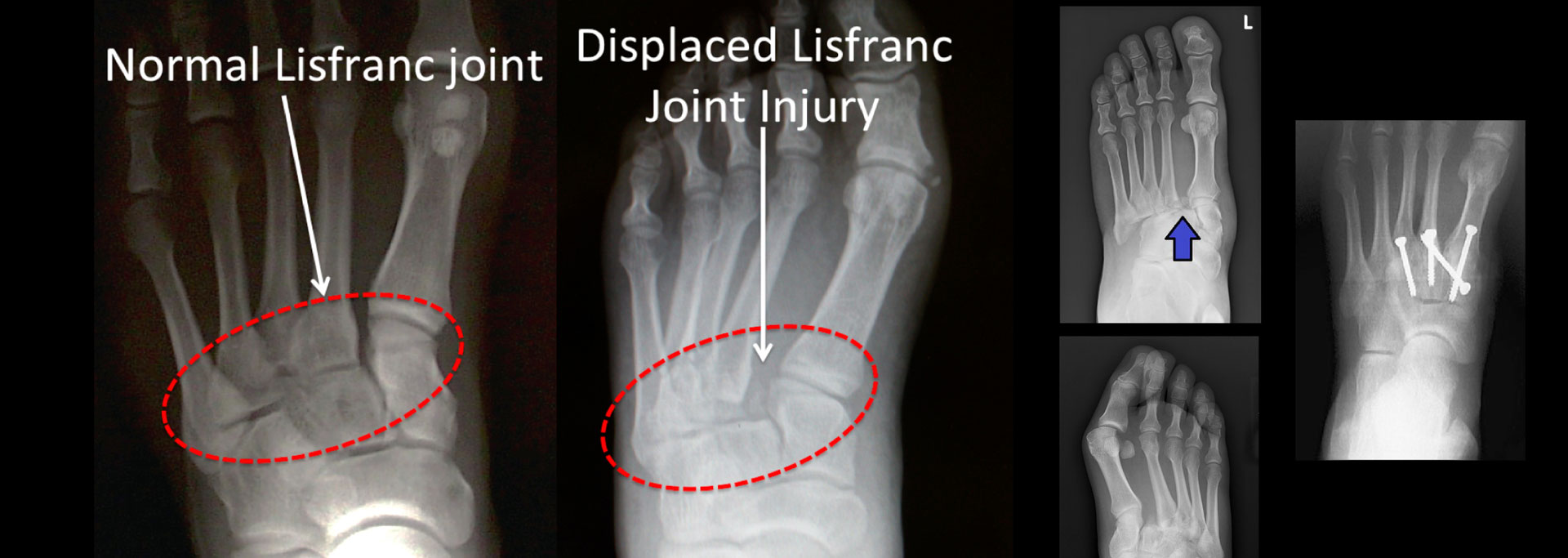 Lisfranc-Fracture