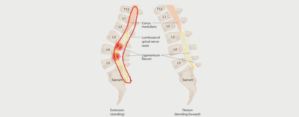 Lumbar Radiculopathy Motus Physical Therapy