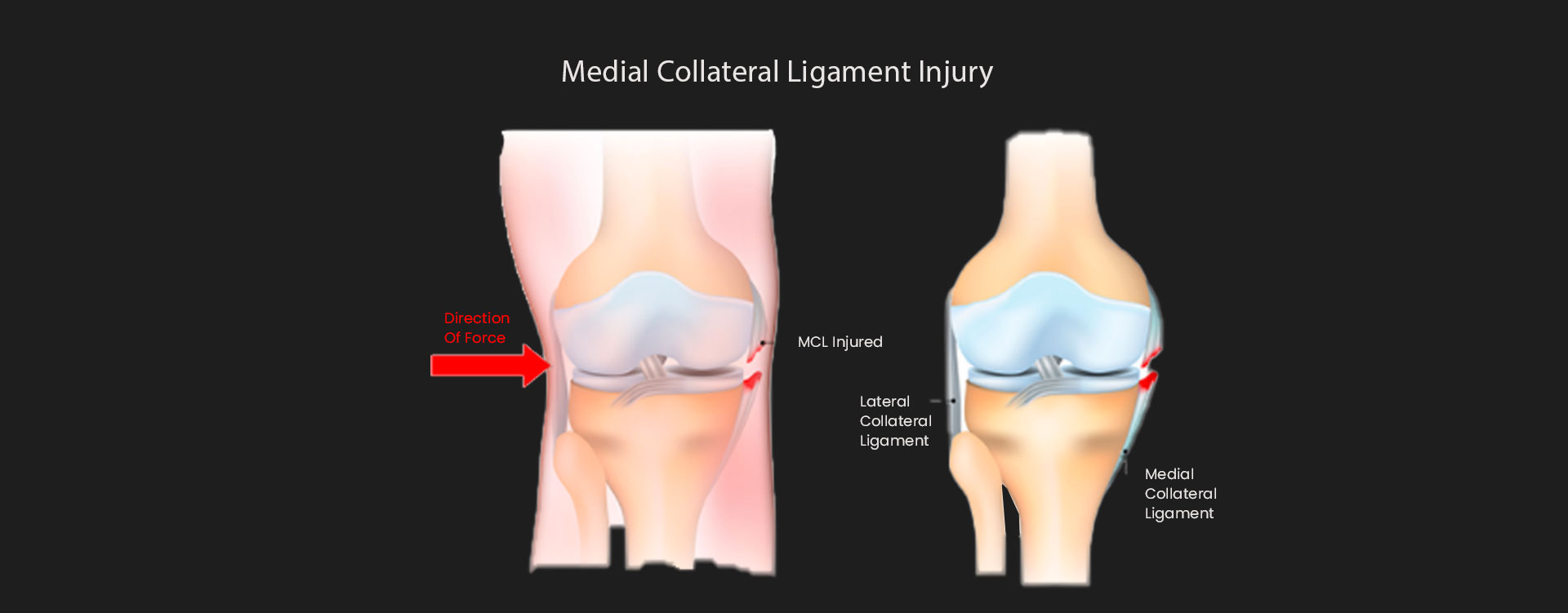 MCL-Injury