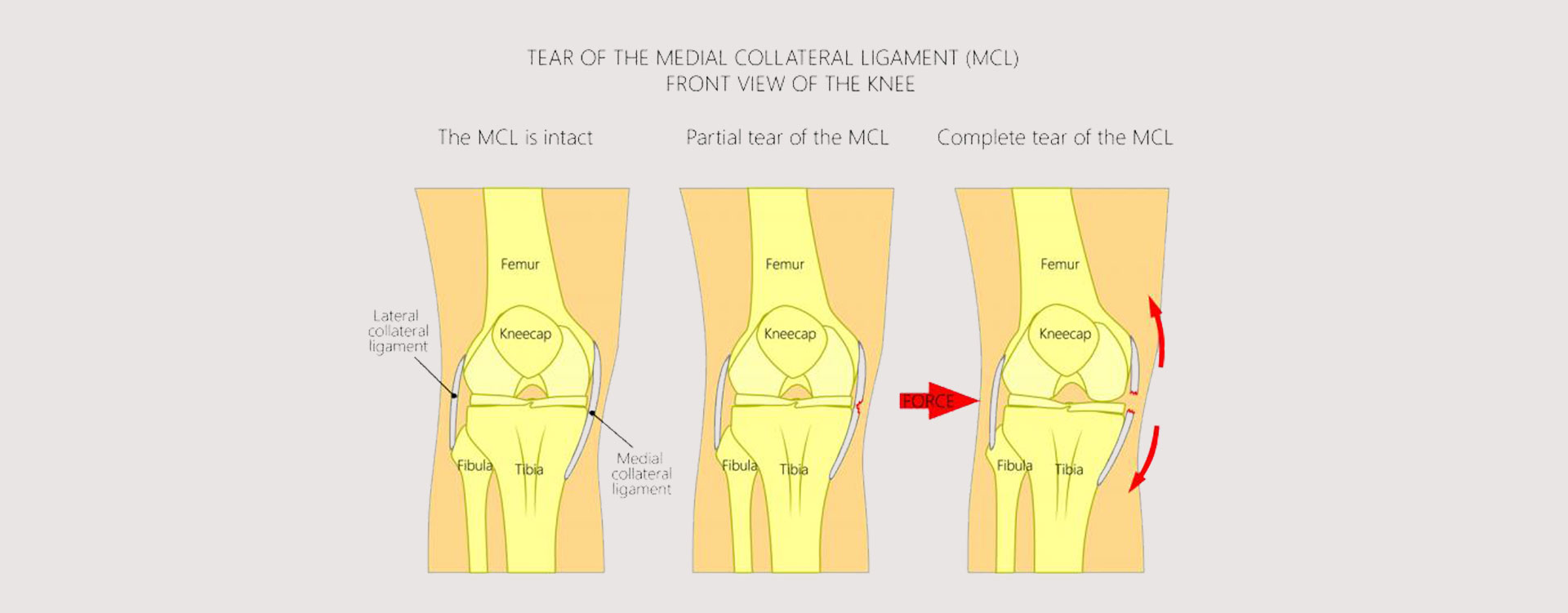 MCL-Injury