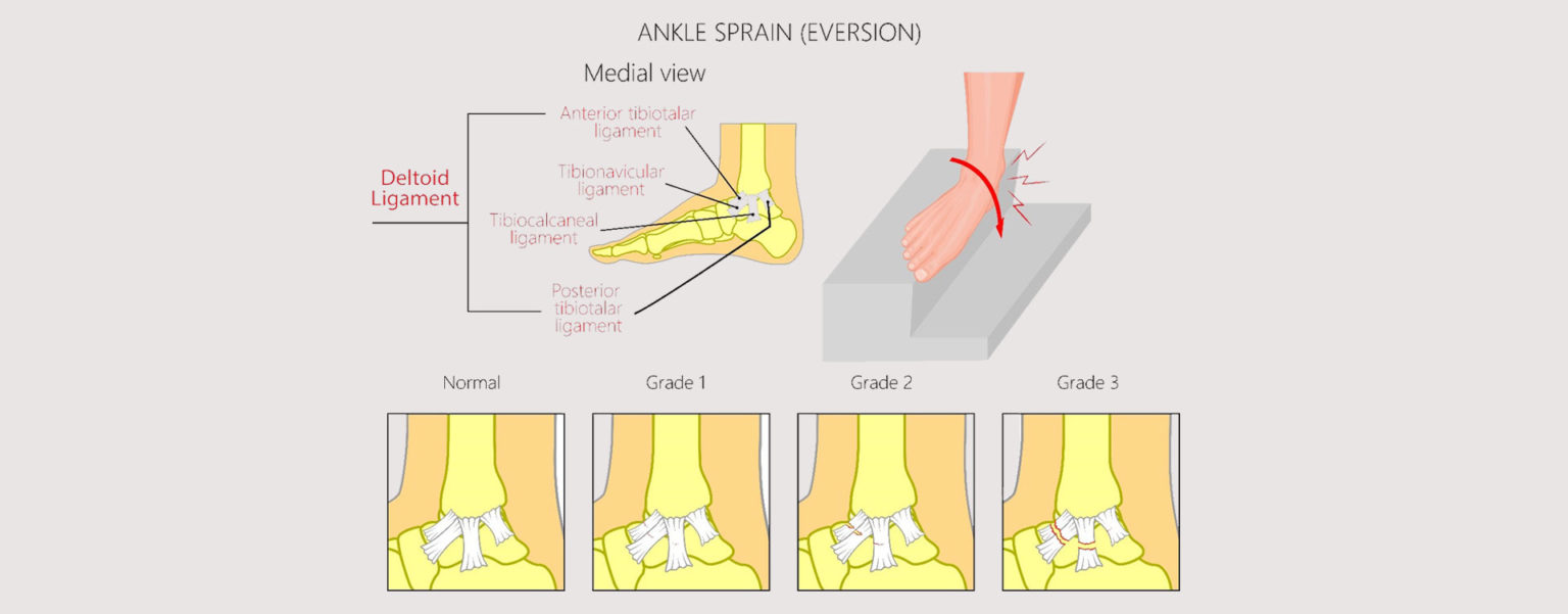 MEDIAL ANKLE SPRAIN - old - MOTUS Physical Therapy