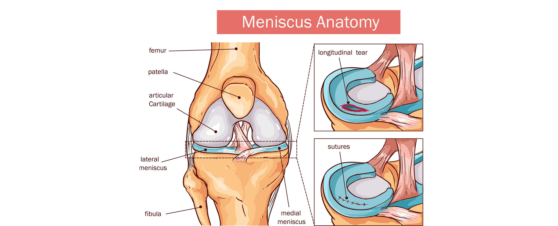 Meniscus-Injury