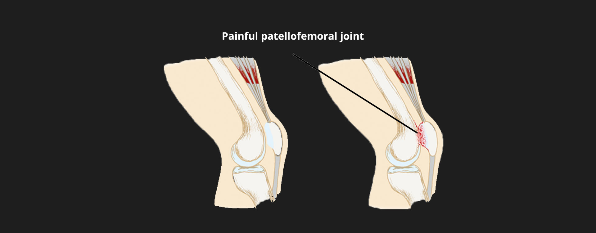 Patellofemoral-Pain