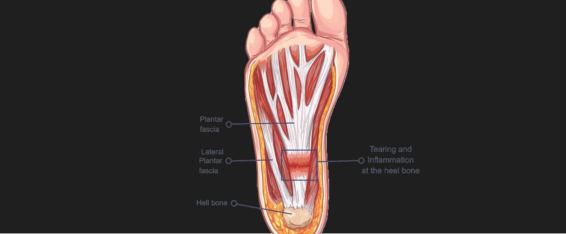 Plantar-Fasciitis