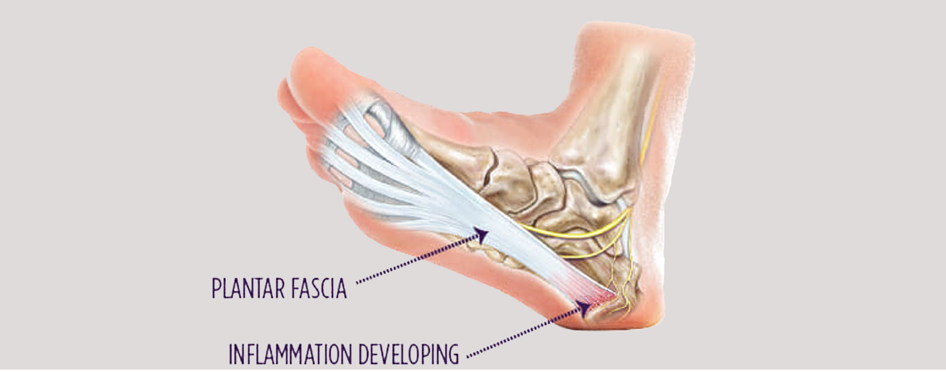 Plantar-Fasciitis