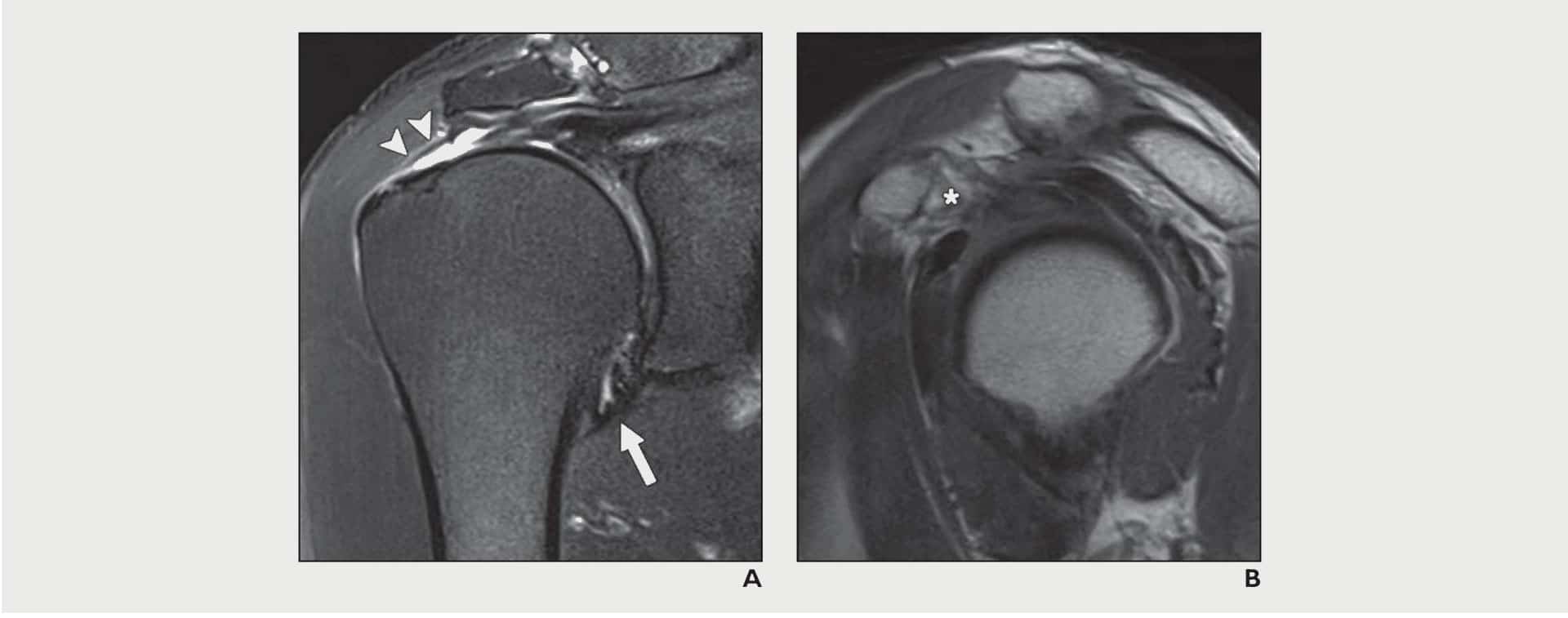 Rotator Cuff Tear - Motus Physical Therapy