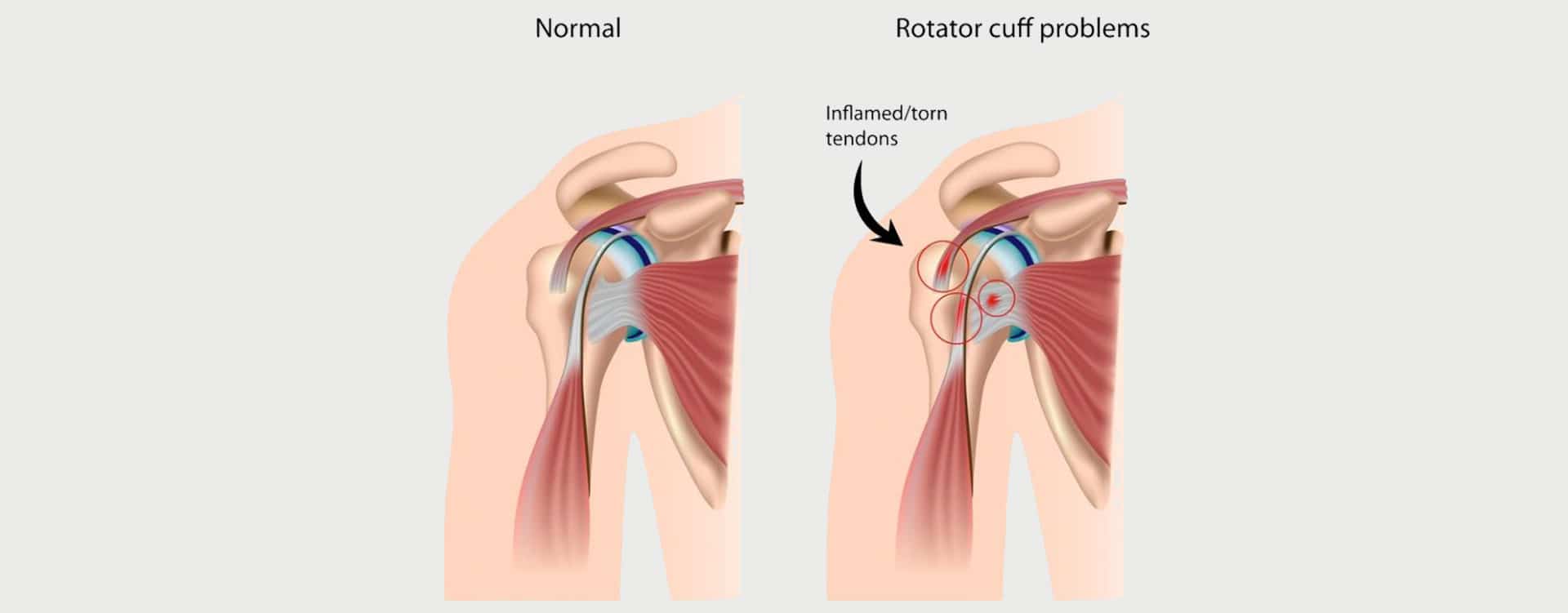 ROTATOR CUFF TENDONITIS MOTUS Physical Therapy