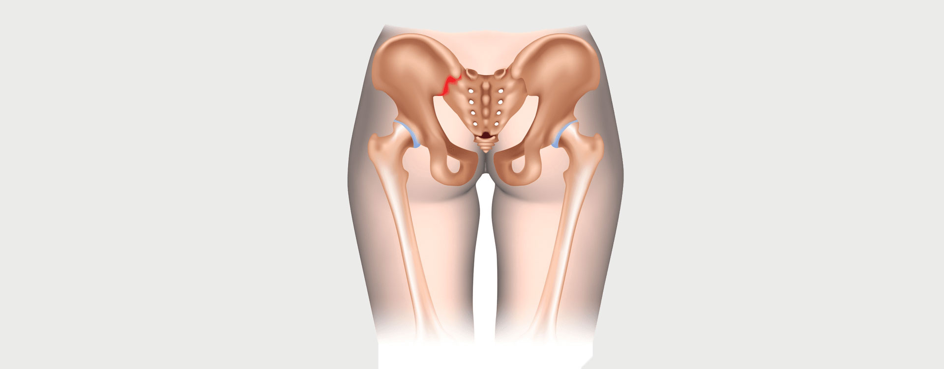 Sacroiliac-SI-Joint-Pain