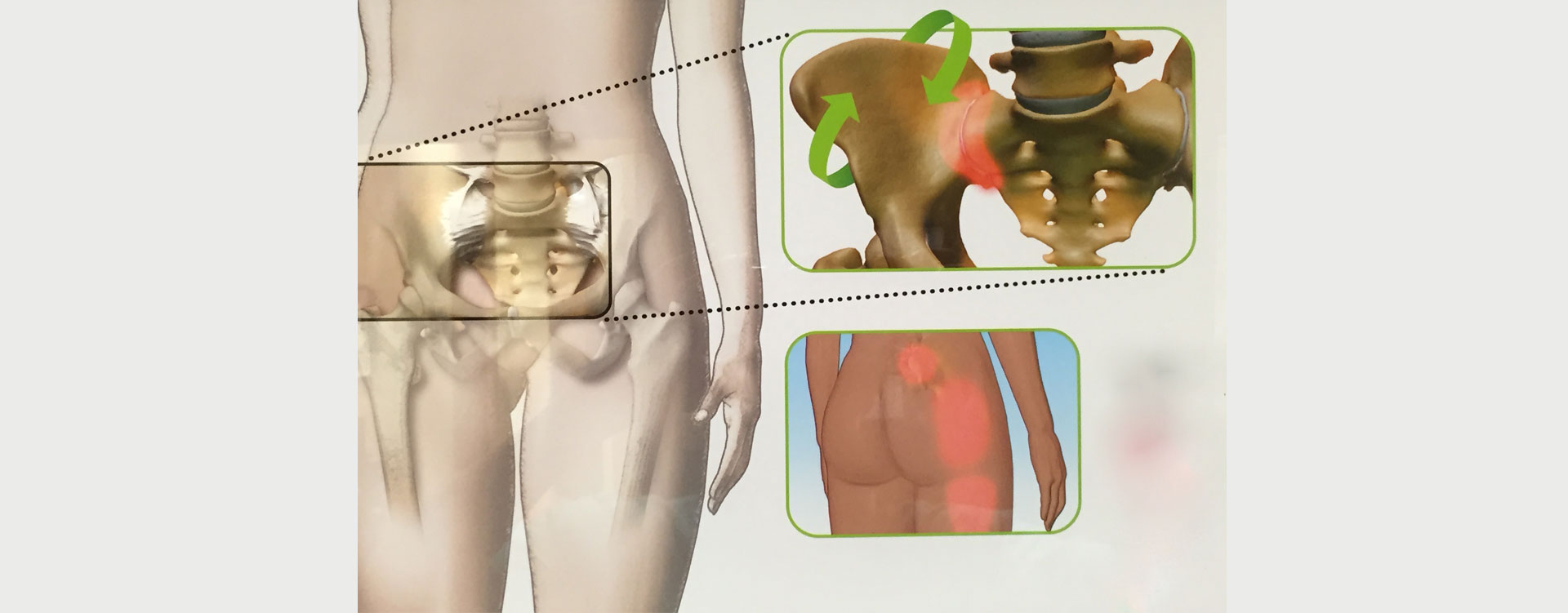 Sacroiliac-SI-Joint-Pain