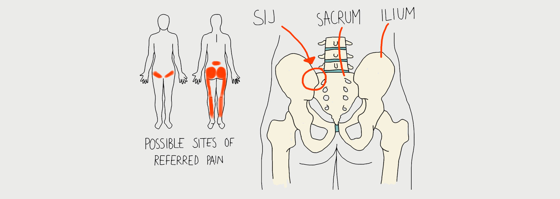 Piriformis Syndrome - Motus Physical Therapy