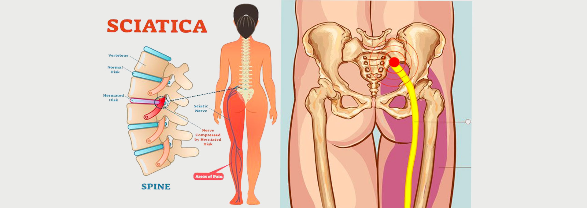 Piriformis Syndrome - Motus Physical Therapy