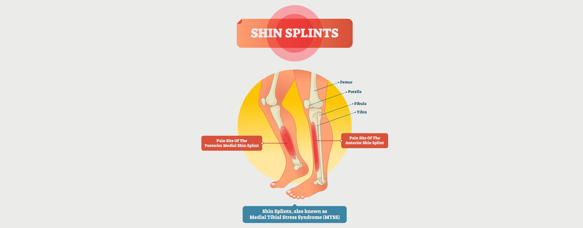 SHIN SPLINTS - MOTUS Physical Therapy